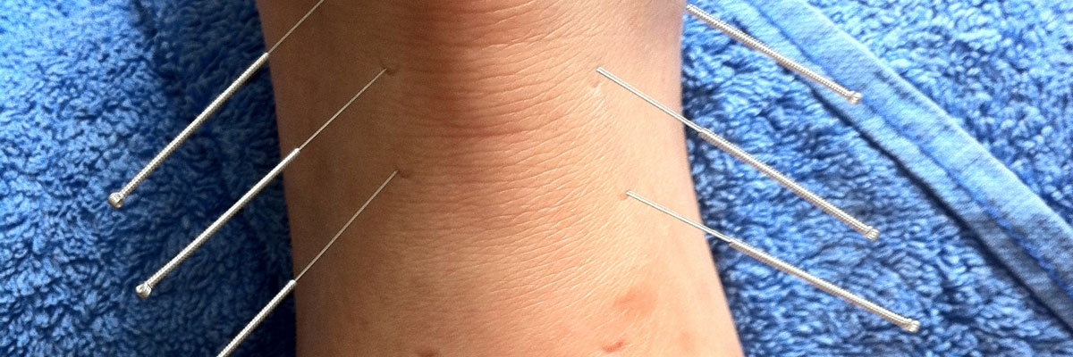 Acupuncture