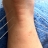 Acupuncture