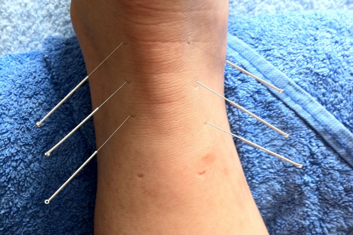 Acupuncture
