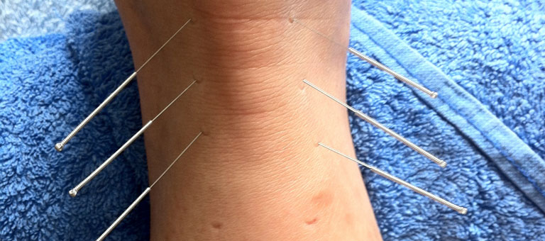 Acupuncture in Battersea